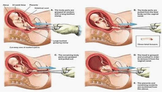 终止妊娠的几种方法(终止妊娠证明怎么开)