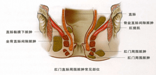 肛瘘是什么症状表现(肛瘘是什么症状表现图片)
