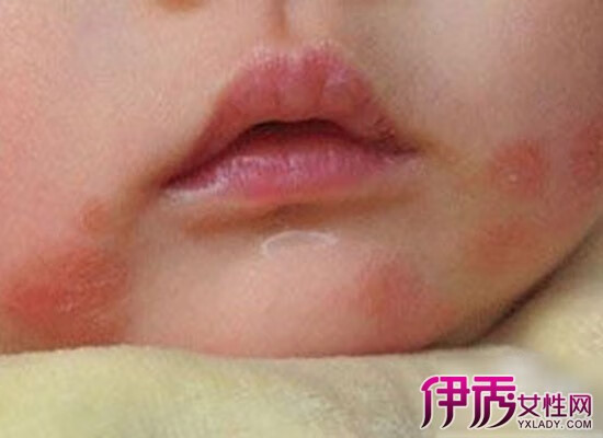 婴儿脸上起小红疙瘩是什么(婴儿宝宝脸上起红疙瘩)