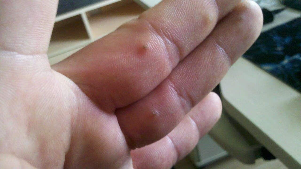 手上长瘊子怎么去除小妙招(手上长瘊子有什么危害)