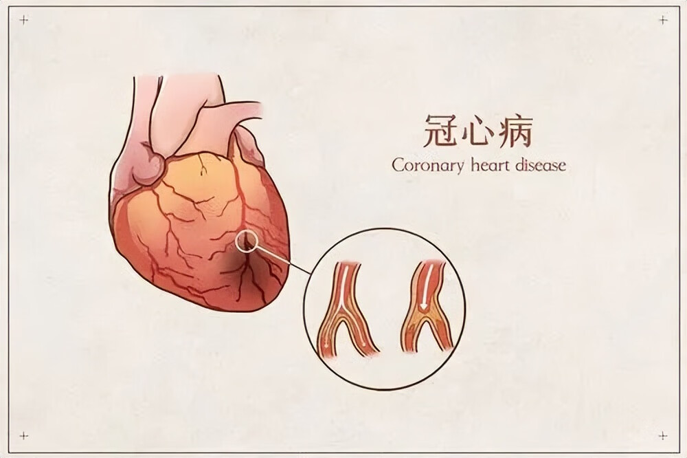 冠心病人吃什么好呢(吃什么对冠心病人有好处)