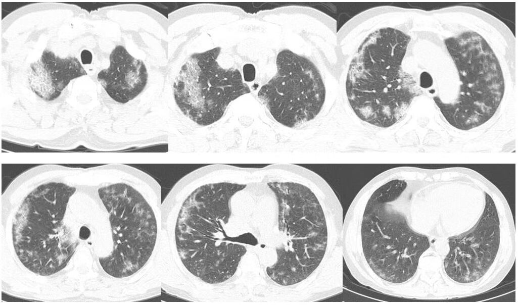 非典型肺炎(新冠肺炎事件)