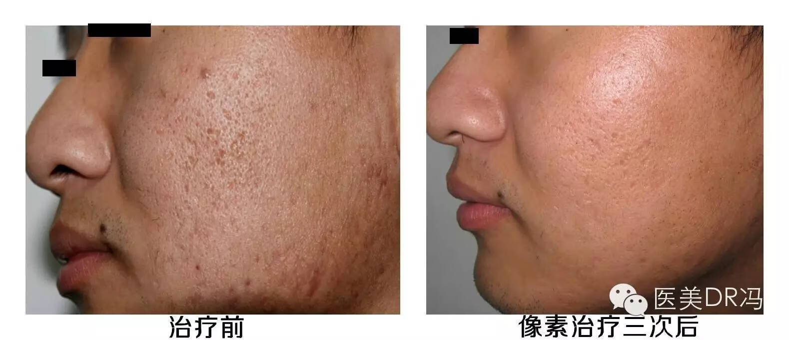 臉上有痘坑怎么治療(臉上一臉痘坑怎么辦)
