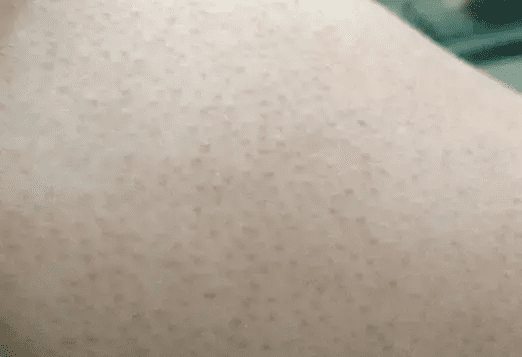 怎么治鸡皮肤(怎么才能治好鸡皮肤)