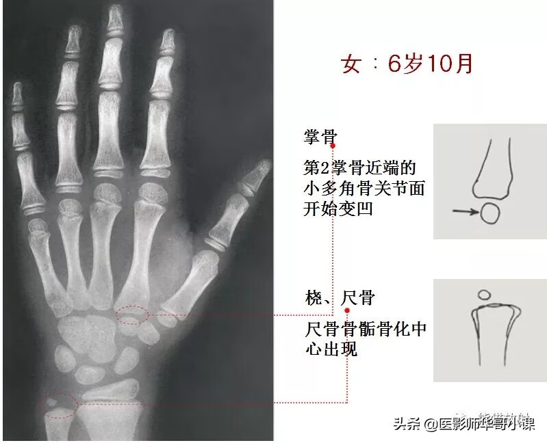 怎样测骨龄?(测骨龄的最佳年龄)