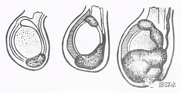 附睾附件图片图片