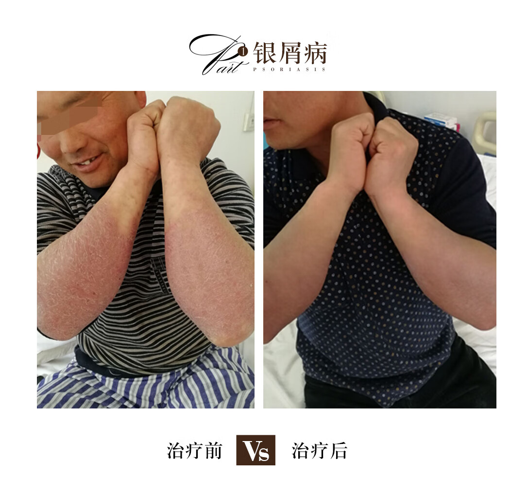 牛皮血癣会遗传吗(牛皮皮癣能传染)