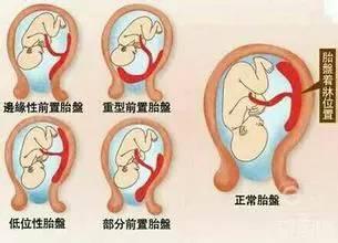 胎盘位置低能顺产吗?(胎盘过低可以顺产吗)