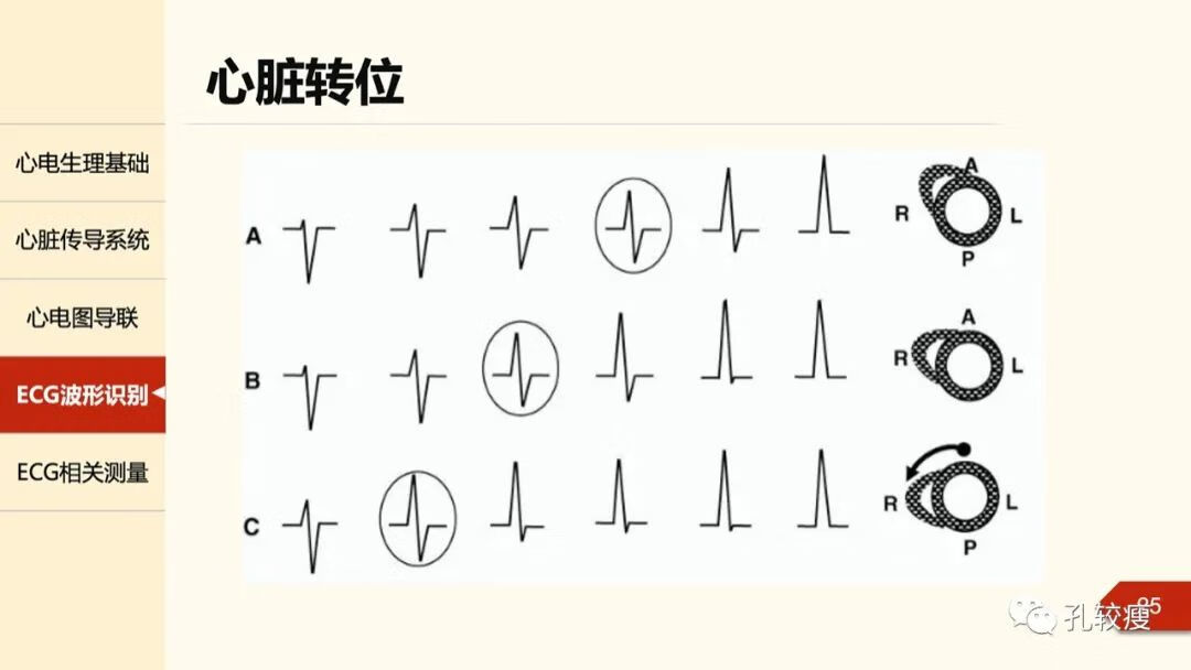 心电图导联位置示意图(心电图机导联位置图)