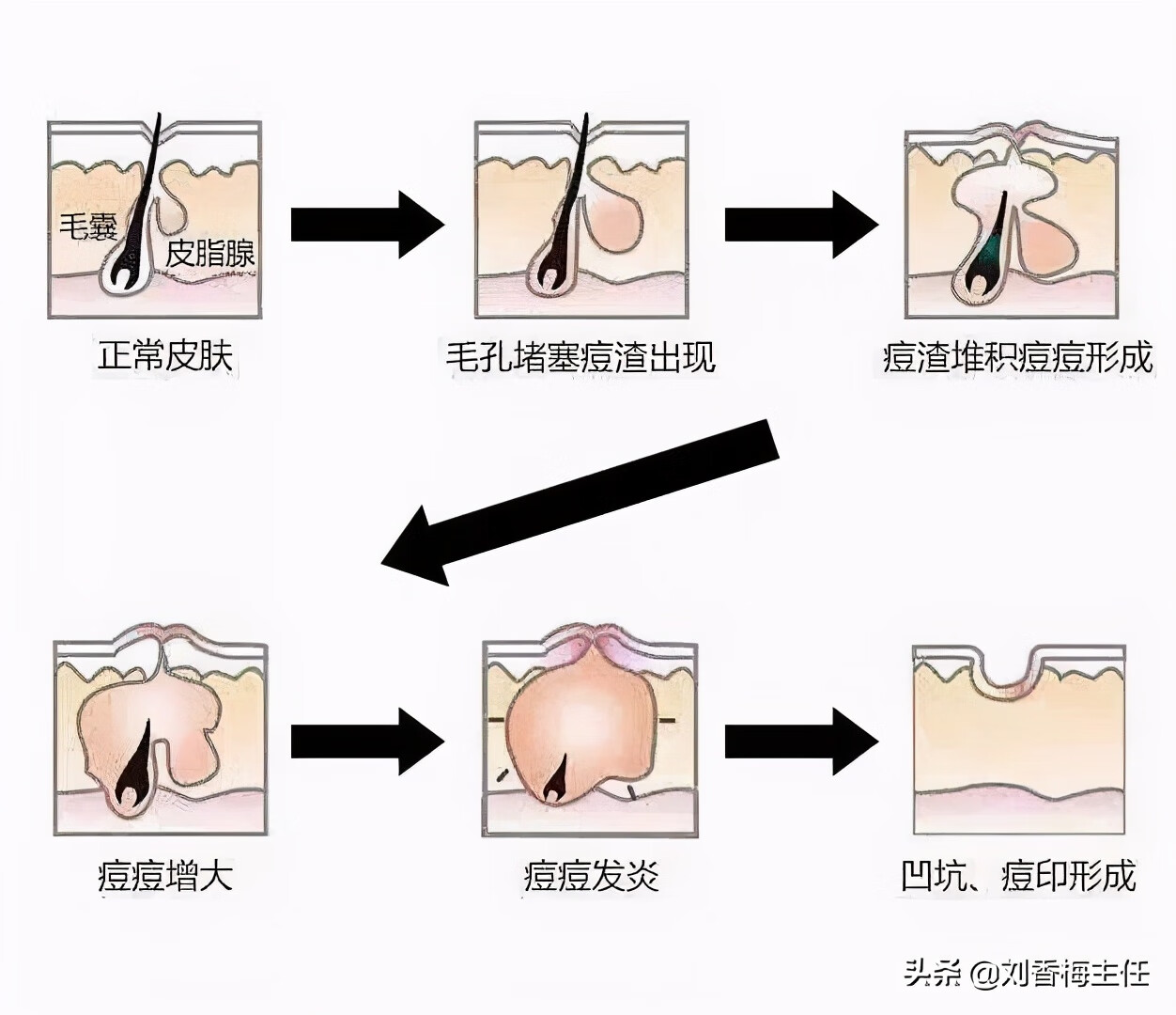有痘坑怎么办啊(治疗痘坑最有效的方法是什么)