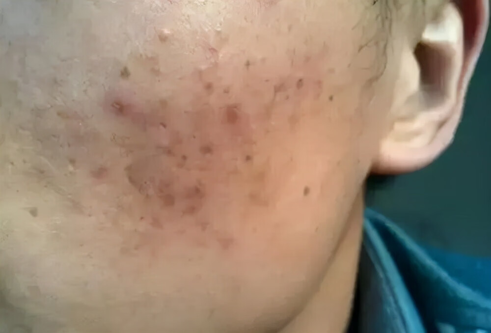 男士去痘印最有效的方法(男士去痘印痘坑小方法)