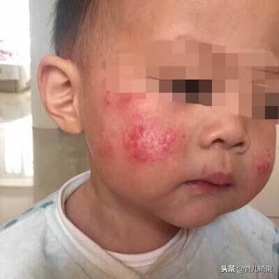 婴儿湿疹图片脸上起湿疹的图片(婴儿皮肤湿疹图片)