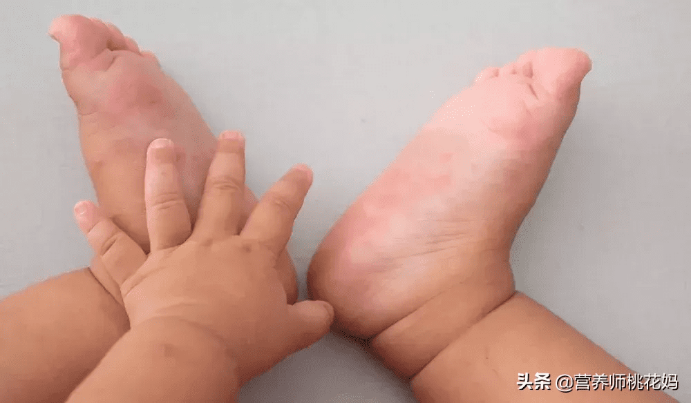 口足手病可以喝奶粉吗(手足口病不能吃什么)