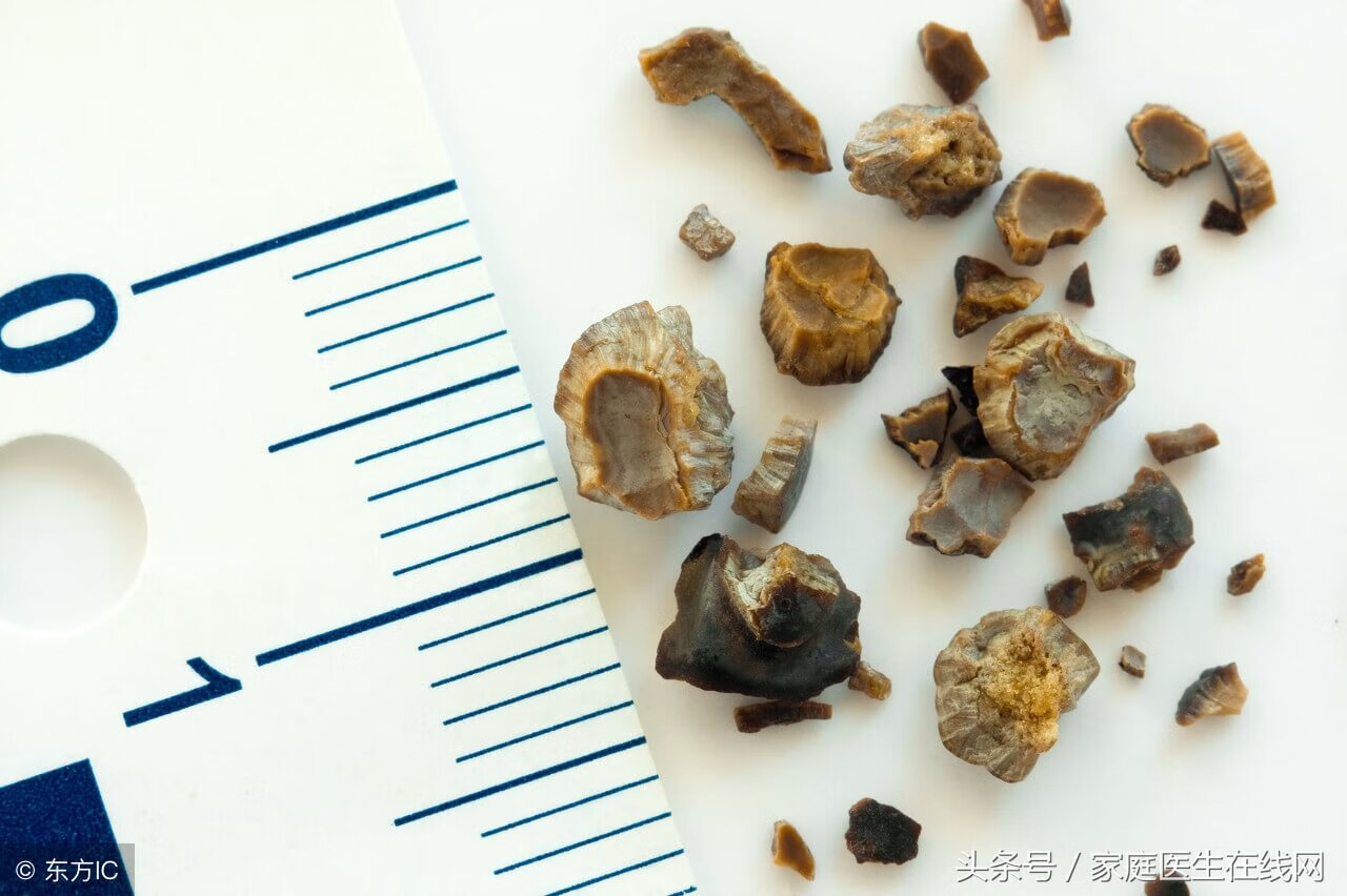 肾结石不能吃什么食物有哪些(肾结石不能吃的食物清单)