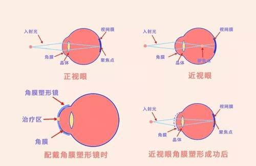 轻微近视眼怎么办(近视眼是怎么造成的)