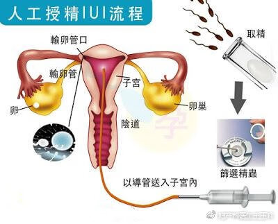 人工授精价格(中心妇产人工授精价格)