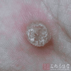 如何治疗鸡眼的方法