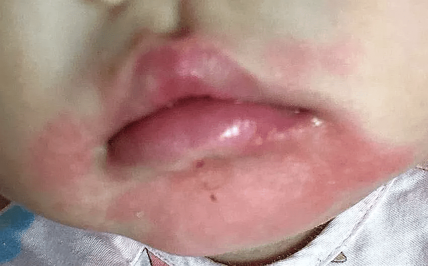 口周皮炎怎么引起的(口周皮炎是怎么引起的)