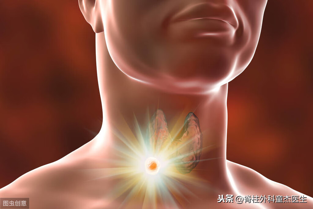 甲状腺肿瘤症状和反应(甲状腺癌的典型症状)