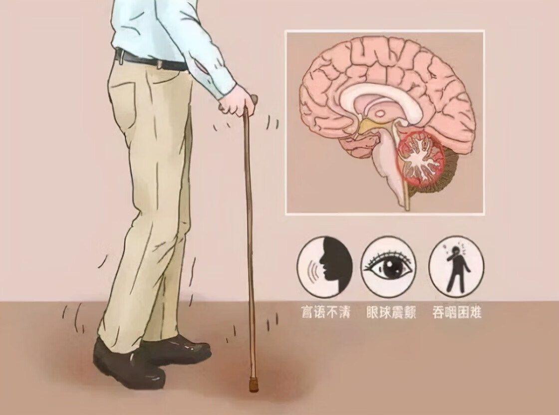 体位性低血压的治疗(低血压治疗方法有哪些)