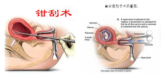 人工流产的并发症不包括(手术流产有哪些并发症)