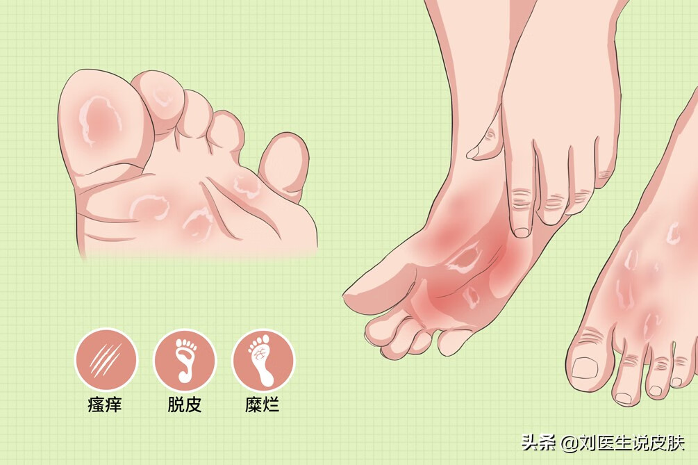 脚痒脚脱皮是什么原因造成的(脚脱皮是因为什么)