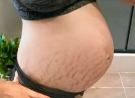 妊娠纹淡化过程(妊娠纹可以淡化到什么程度)