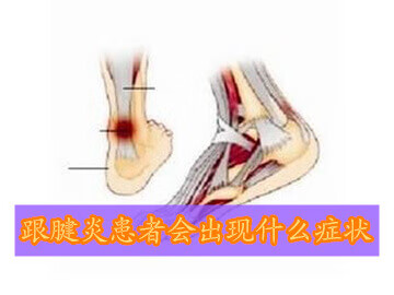 急性跟腱炎的症状(跟腱炎是哪个部位图)