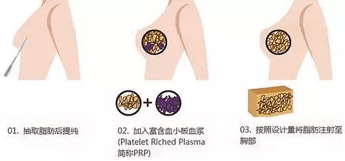 明星怎么隆胸(怎样让胸变得越来越大)