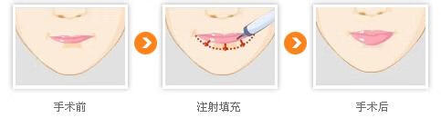 胶原蛋白丰唇效果怎么样(胶原蛋白肽可以丰胸吗)