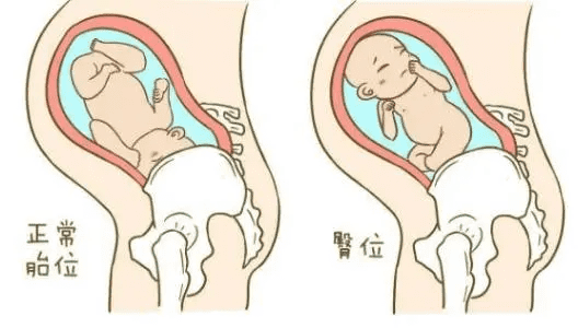 什么是难产儿(难产接生的定义)