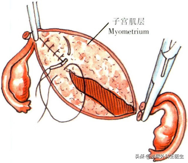 切除子宫 影响(子宫切除会影响什么)
