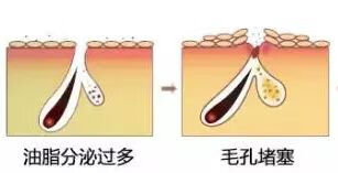 去黑头的最佳方法(去黑头的有效方法)