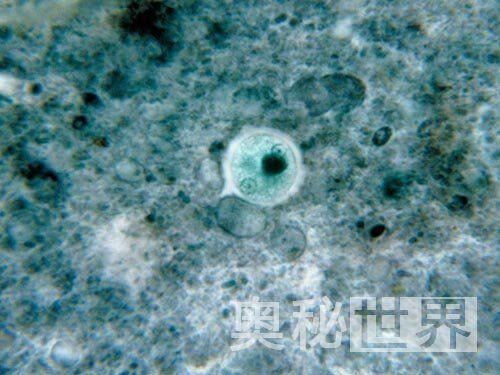 人体寄生虫有哪些(人体寄生虫图片)