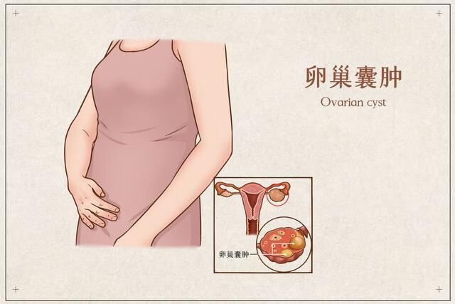 女性卵巢囊肿影响怀孕吗(囊肿影响怀孕吗)