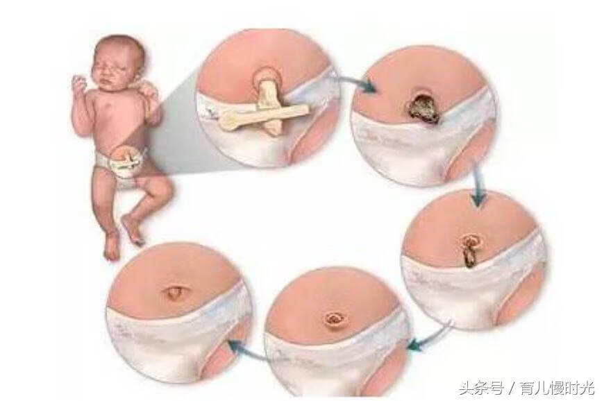 小儿腹泻贴贴哪里(小儿腹泻贴有用吗)