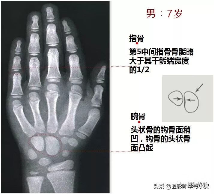 怎样测骨龄?(测骨龄的最佳年龄)