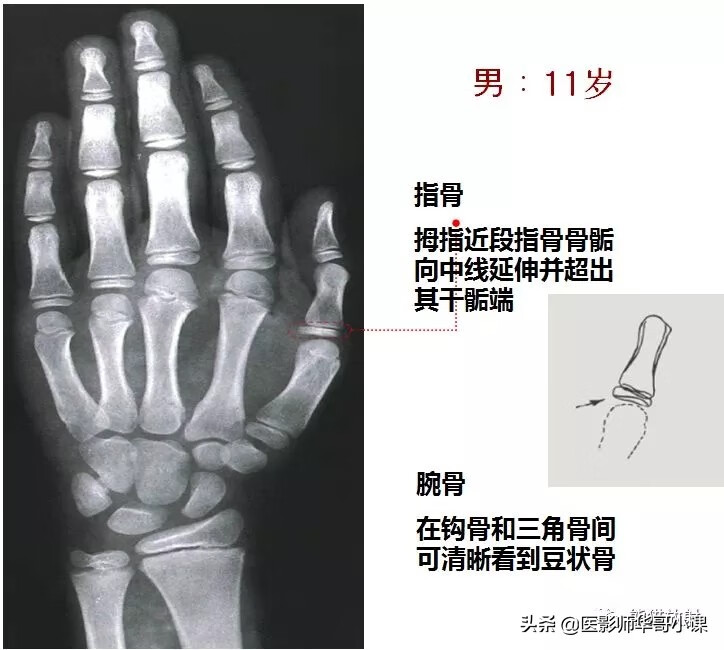 怎样测骨龄?(测骨龄的最佳年龄)