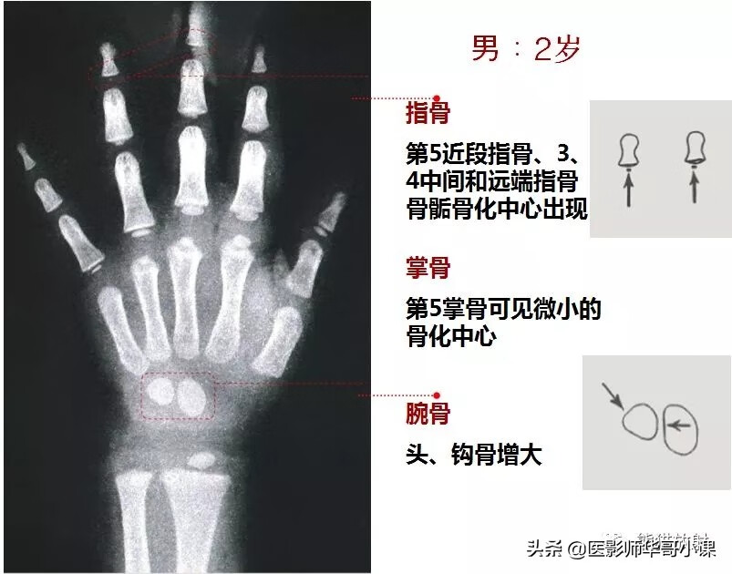 怎样测骨龄?(测骨龄的最佳年龄)