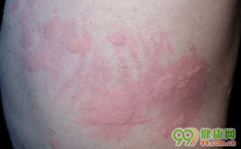 急性过敏性荨麻疹治疗(过敏性荨麻疹能根治吗)