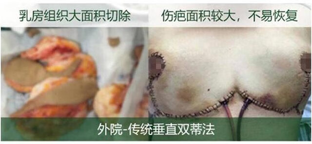 乳头下垂是什么原因造成的(乳房下垂是什么原因)