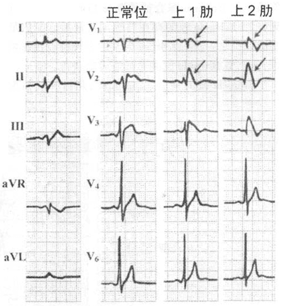 心电图导联的位置是(心电图全导联位置图)