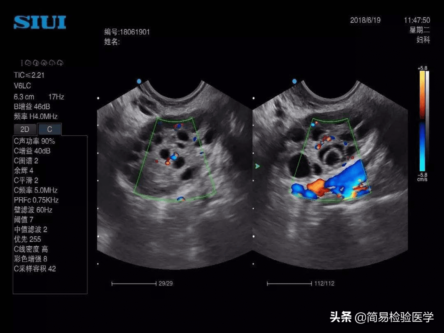 绒毛膜促性腺激素标准(人绒毛膜促性腺激素)