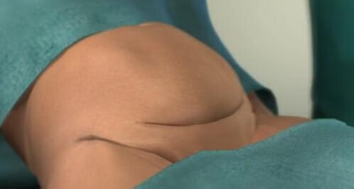 剖腹产过程及步骤组图(剖腹产的真实过程)