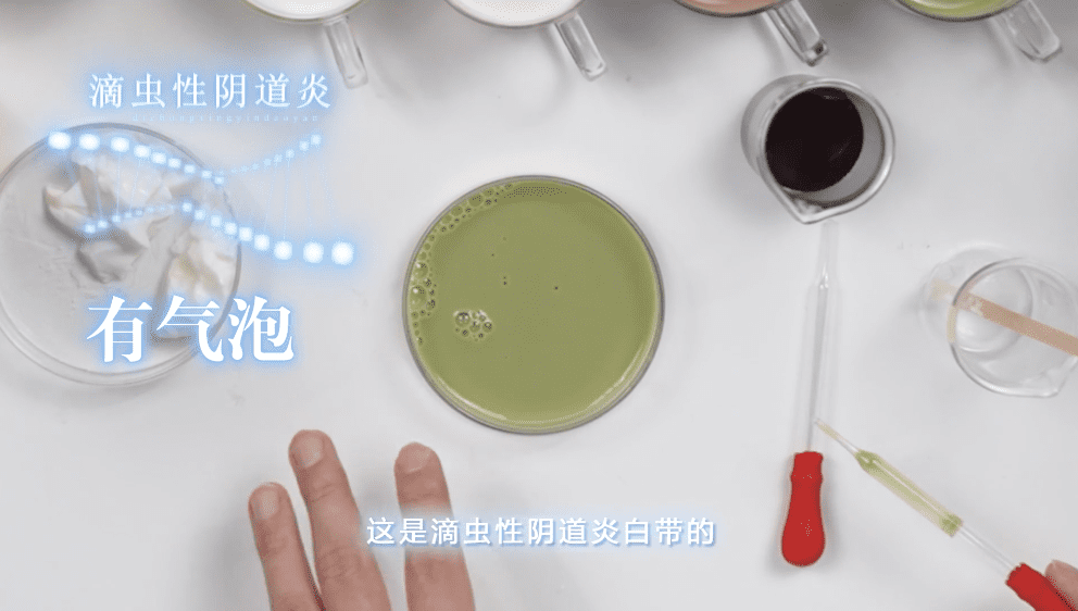 白帶白色豆腐渣分泌物照片