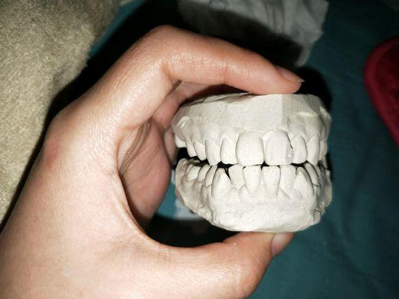 牙套要带多久?(戴牙套一般戴多久)