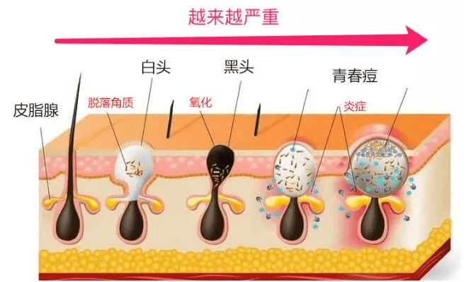 草莓鼻子是怎么形成的