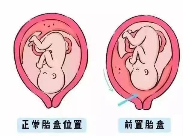人胎盘(生孩子的胎盘怎么处理)