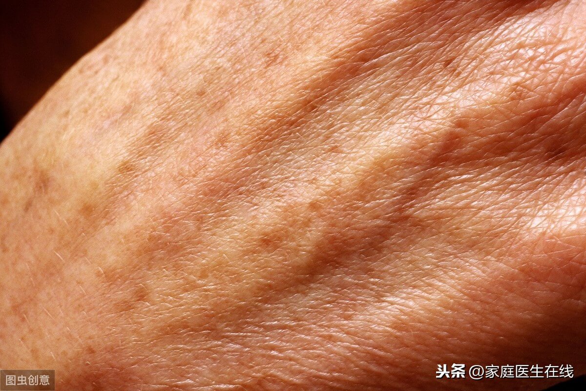 老年斑怎样去掉?(老年斑怎样才能彻底的去掉)