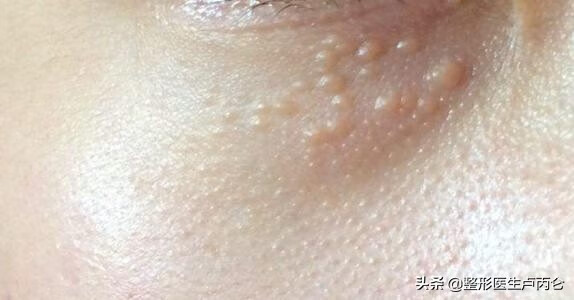 眼睑上长小颗粒叫什么(下眼睑边缘上长透明小颗粒)